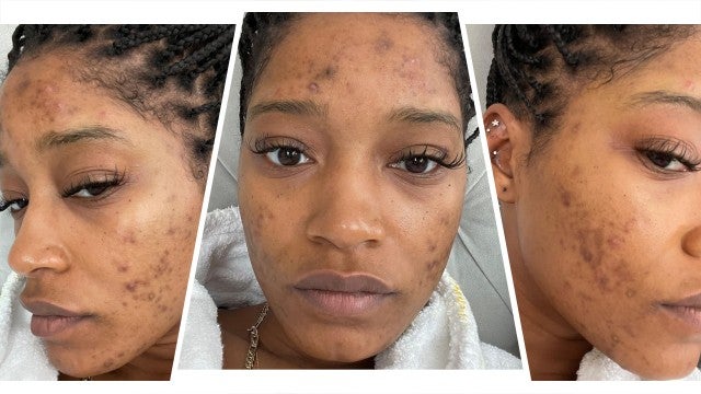 Keke Palmer Shows Acne After Revealing She Has Polycystic Ovary Syndrome
