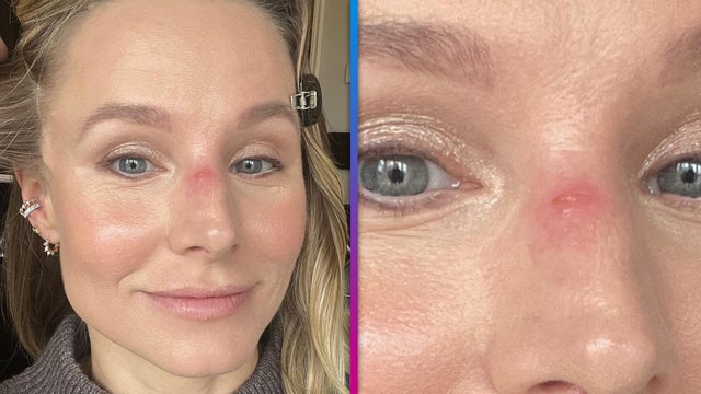 Kristen Bell Shows Off Nose Injury From Daughter's 'Buck Teeth'