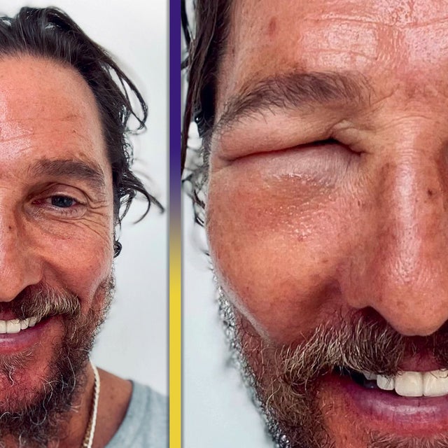 Matthew McConaughey Shows Off Wild Bee Sting Swelling